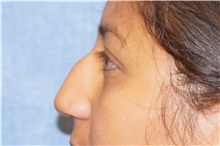 Rhinoplasty Before Photo by George John Alexander, MD, FACS; Las Vegas, NV - Case 34054
