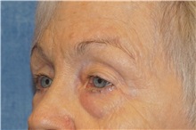 Eyelid Surgery Before Photo by George John Alexander, MD, FACS; ,  - Case 34061