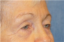Eyelid Surgery After Photo by George John Alexander, MD, FACS; ,  - Case 34061