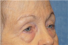 Eyelid Surgery Before Photo by George John Alexander, MD, FACS; ,  - Case 34061