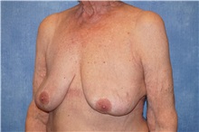 Breast Implant Removal After Photo by George John Alexander, MD, FACS; Las Vegas, NV - Case 34063