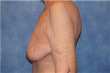 Breast Implant Removal After Photo by George John Alexander, MD, FACS; Las Vegas, NV - Case 34063