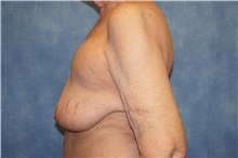 Breast Implant Removal Before Photo by George John Alexander, MD, FACS; Las Vegas, NV - Case 34063