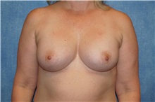 Breast Augmentation After Photo by George John Alexander, MD, FACS; ,  - Case 34275