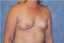 Breast Augmentation Before Photo by George John Alexander, MD, FACS; ,  - Case 34275