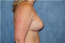 Breast Augmentation After Photo by George John Alexander, MD, FACS; ,  - Case 34275