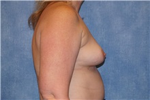 Breast Augmentation Before Photo by George John Alexander, MD, FACS; ,  - Case 34275