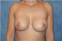 Breast Augmentation After Photo by George John Alexander, MD, FACS; Las Vegas, NV - Case 34276