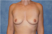 Breast Augmentation Before Photo by George John Alexander, MD, FACS; Las Vegas, NV - Case 34276