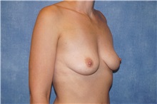 Breast Augmentation Before Photo by George John Alexander, MD, FACS; ,  - Case 34276