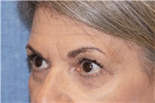 Eyelid Surgery After Photo by George John Alexander, MD, FACS; ,  - Case 35823