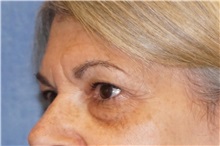 Eyelid Surgery Before Photo by George John Alexander, MD, FACS; ,  - Case 35823