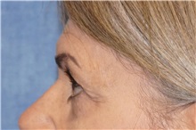 Eyelid Surgery After Photo by George John Alexander, MD, FACS; ,  - Case 35823