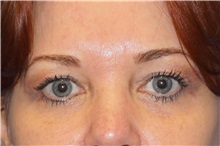 Eyelid Surgery After Photo by George John Alexander, MD, FACS; Las Vegas, NV - Case 35825