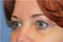 Eyelid Surgery After Photo by George John Alexander, MD, FACS; ,  - Case 35825