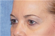 Eyelid Surgery Before Photo by George John Alexander, MD, FACS; ,  - Case 35825