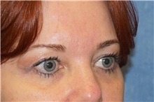 Eyelid Surgery After Photo by George John Alexander, MD, FACS; ,  - Case 35825