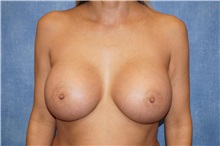 Breast Augmentation After Photo by George John Alexander, MD, FACS; Las Vegas, NV - Case 35828