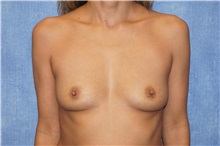 Breast Augmentation Before Photo by George John Alexander, MD, FACS; Las Vegas, NV - Case 35828