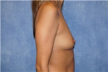 Breast Augmentation Before Photo by George John Alexander, MD, FACS; ,  - Case 35828