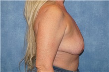 Breast Implant Removal After Photo by George John Alexander, MD, FACS; ,  - Case 35829