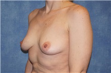 Breast Implant Removal After Photo by George John Alexander, MD, FACS; ,  - Case 35830