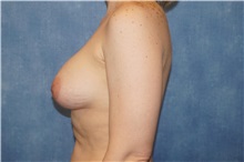 Breast Implant Removal Before Photo by George John Alexander, MD, FACS; ,  - Case 35830