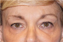 Brow Lift After Photo by George John Alexander, MD, FACS; ,  - Case 36115
