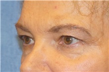 Brow Lift Before Photo by George John Alexander, MD, FACS; ,  - Case 36115
