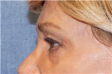 Brow Lift After Photo by George John Alexander, MD, FACS; ,  - Case 36115