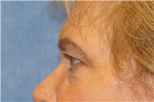 Brow Lift Before Photo by George John Alexander, MD, FACS; ,  - Case 36115