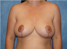 Breast Reduction After Photo by George John Alexander, MD, FACS; ,  - Case 36117