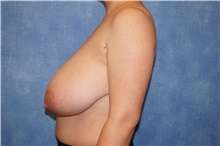 Breast Reduction Before Photo by George John Alexander, MD, FACS; ,  - Case 36117