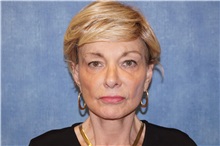 Facelift After Photo by George John Alexander, MD, FACS; ,  - Case 36120