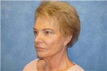 Facelift Before Photo by George John Alexander, MD, FACS; ,  - Case 36120