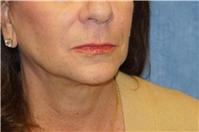 Facelift After Photo by George John Alexander, MD, FACS; ,  - Case 36121
