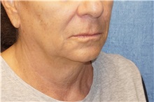 Facelift Before Photo by George John Alexander, MD, FACS; ,  - Case 36121