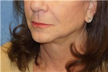 Facelift After Photo by George John Alexander, MD, FACS; ,  - Case 36121