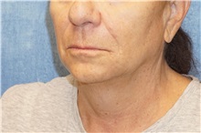 Facelift Before Photo by George John Alexander, MD, FACS; ,  - Case 36121