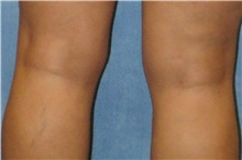 Liposuction After Photo by George John Alexander, MD, FACS; ,  - Case 36122