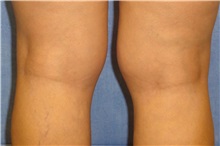 Liposuction Before Photo by George John Alexander, MD, FACS; ,  - Case 36122