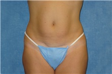 Liposuction After Photo by George John Alexander, MD, FACS; Las Vegas, NV - Case 36124