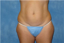 Liposuction Before Photo by George John Alexander, MD, FACS; Las Vegas, NV - Case 36124