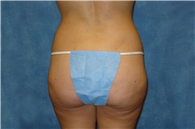 Liposuction After Photo by George John Alexander, MD, FACS; ,  - Case 36124