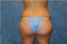 Liposuction Before Photo by George John Alexander, MD, FACS; ,  - Case 36124
