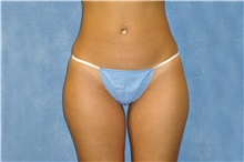 Liposuction Before Photo by George John Alexander, MD, FACS; Las Vegas, NV - Case 36128