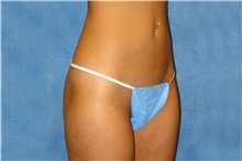 Liposuction After Photo by George John Alexander, MD, FACS; Las Vegas, NV - Case 36128