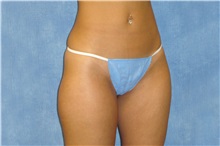 Liposuction Before Photo by George John Alexander, MD, FACS; Las Vegas, NV - Case 36128