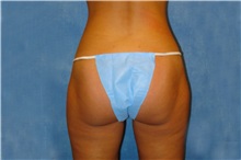 Liposuction After Photo by George John Alexander, MD, FACS; Las Vegas, NV - Case 36128