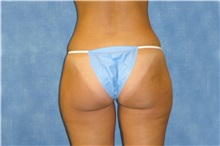 Liposuction Before Photo by George John Alexander, MD, FACS; Las Vegas, NV - Case 36128